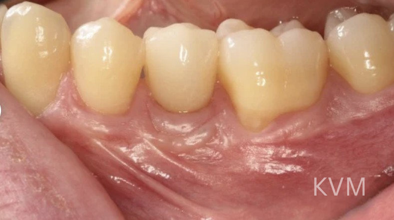 Andre - After First molar
