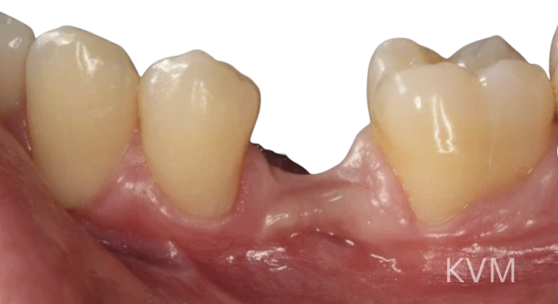 Andre - Before First molar