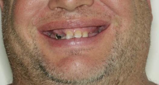 Frank - Before Anterior implant bridge