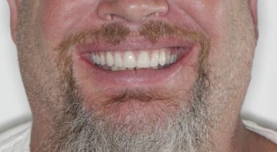 Frank - After Anterior implant bridge