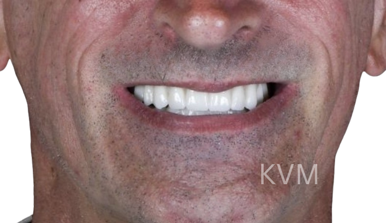 Harry - After All on 4 implants