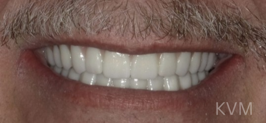 Sam - After All on 4 implants