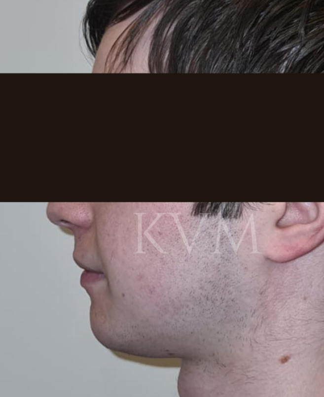 Sam - After Genioplasty