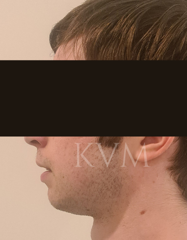 Sam - After Genioplasty