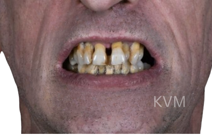 Harry - Before Zygomatic