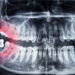 wisdom tooth removal