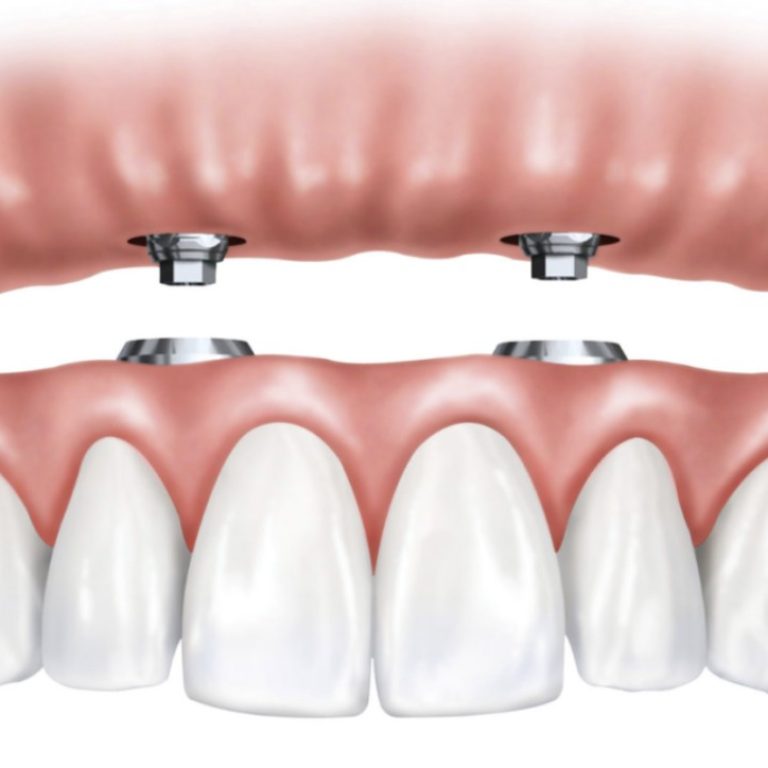 Implant supported dentures